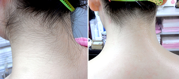 The Backシェービング